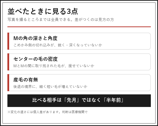 生え際の写真を並べたときに見る3点（Mの角の深さ・センターの密度・産毛の有無）の図解