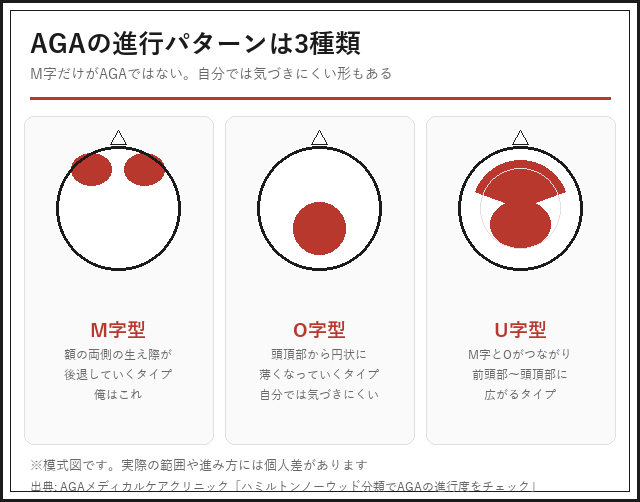 AGAの進行パターン3種(M字型・O字型・U字型)の図解