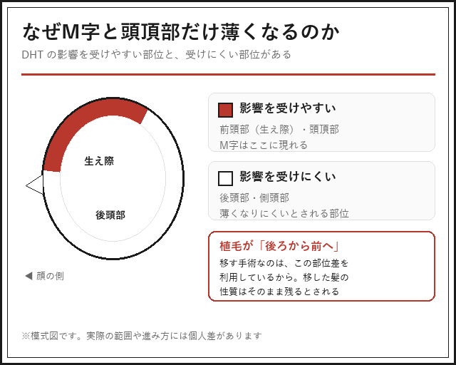 DHTの影響を受けやすい部位（前頭部・頭頂部）と受けにくい部位（後頭部・側頭部）を示した頭部の模式図