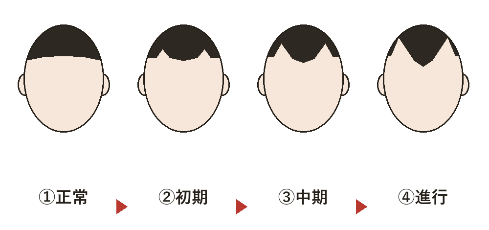M字ハゲの進行4段階の図解（こめかみの生え際がM字型に後退していく）