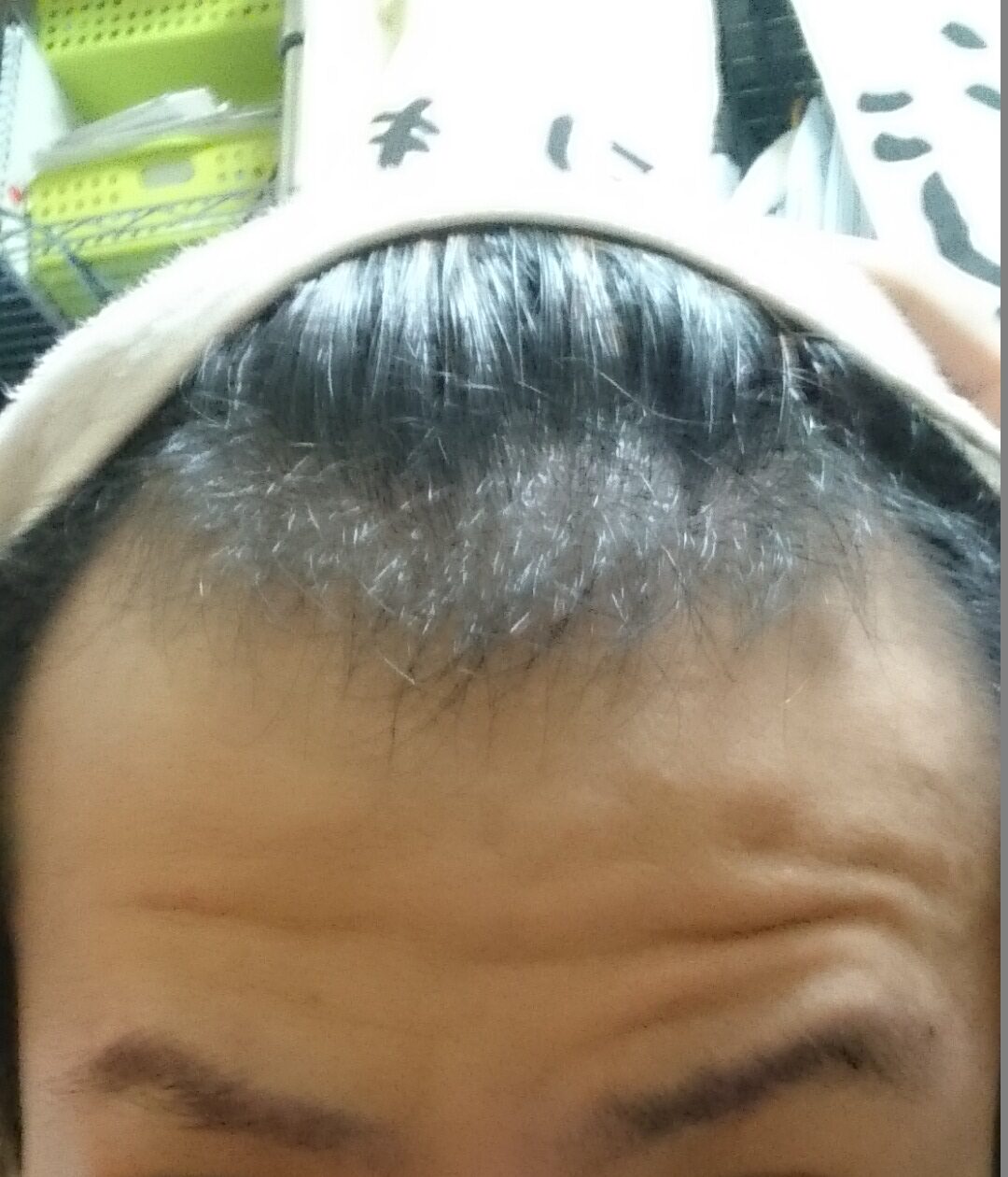 2015年・25歳の頃の生え際