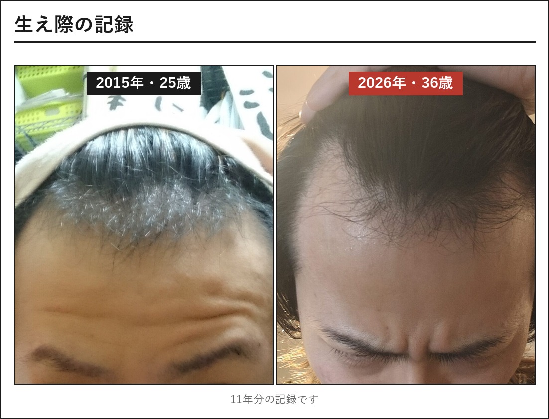 生え際の2015年と2026年の比較写真